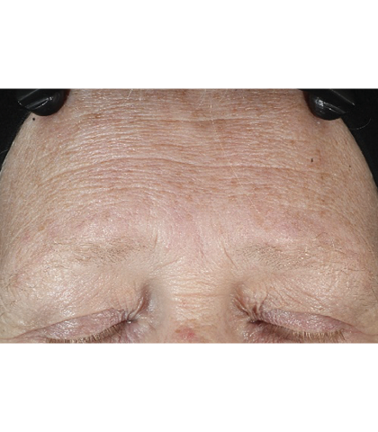 before treatment image
