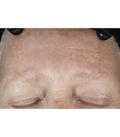 after treatment image