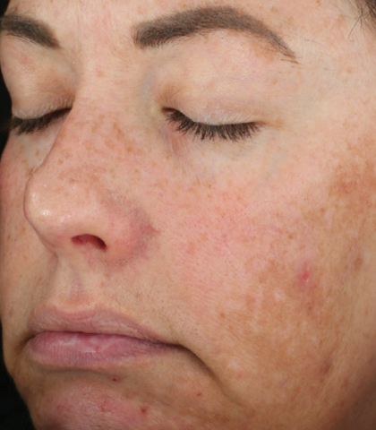 before treatment image