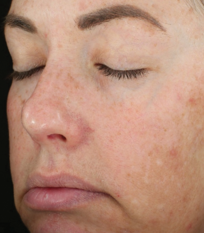 after treatment image