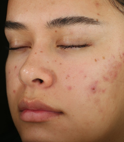 before treatment image