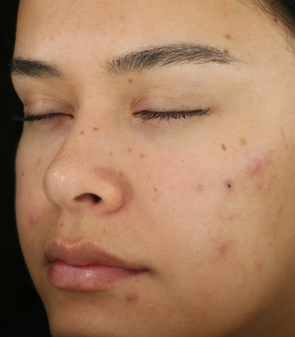 after treatment image