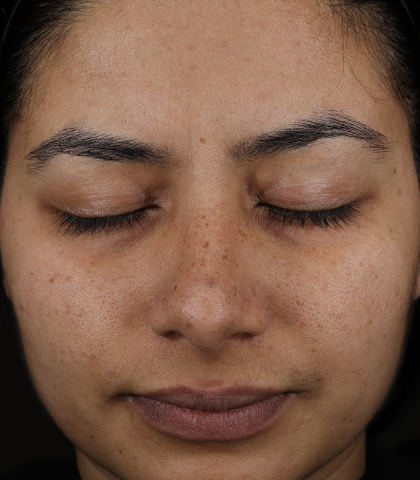 before treatment image