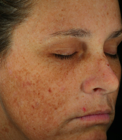 before treatment image