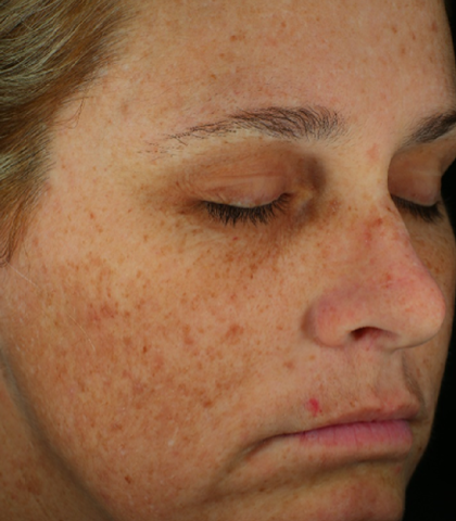 after treatment image